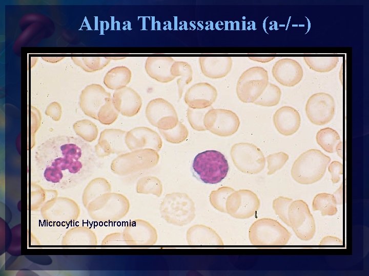 Alpha Thalassaemia (a-/--) Microcytic Hypochromia 