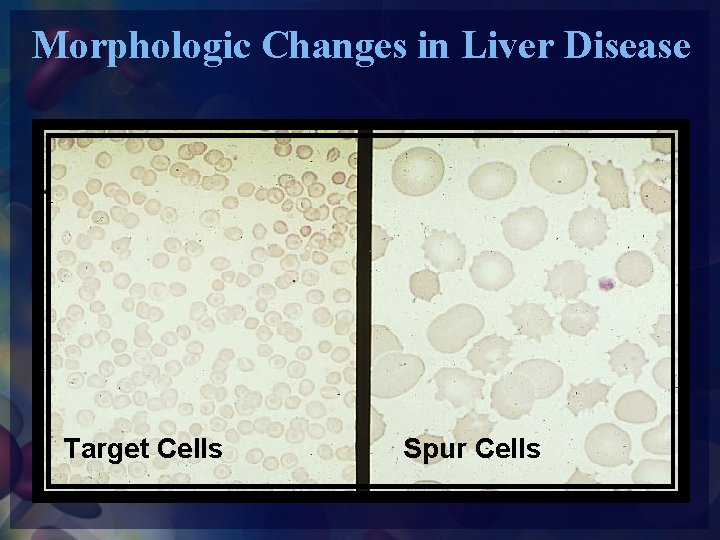 Morphologic Changes in Liver Disease Target Cells Spur Cells 