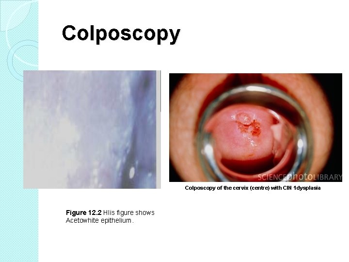 Colposcopy of the cervix (centre) with CIN 1 dysplasia Figure 12. 2 Hlis figure