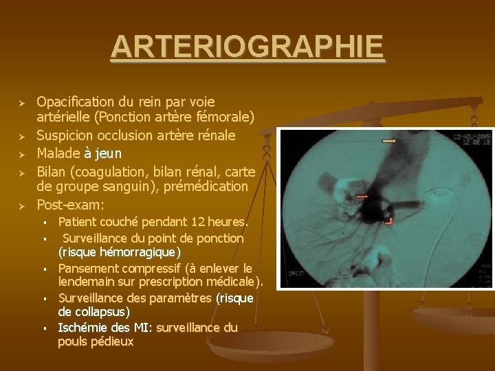 ARTERIOGRAPHIE Opacification du rein par voie artérielle (Ponction artère fémorale) Suspicion occlusion artère rénale
