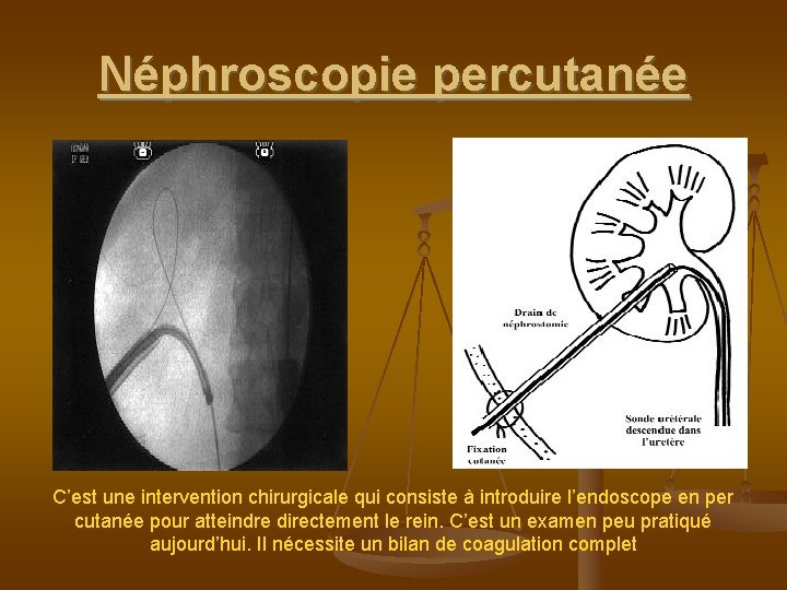 Néphroscopie percutanée C’est une intervention chirurgicale qui consiste à introduire l’endoscope en per cutanée