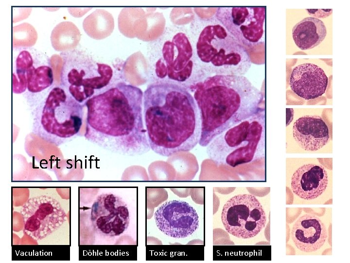Left shift Vaculation Döhle bodies Toxic gran. S. neutrophil 14 