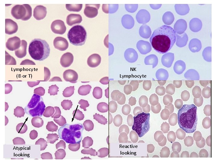 Lymphocyte (B or T) Atypical looking NK Lymphocyte Reactive looking 17 