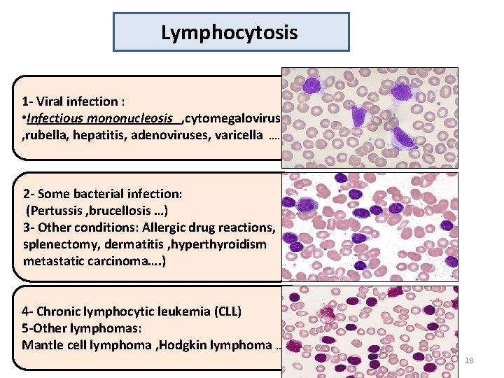 Lymphocytosis 1 - Viral infection : • Infectious mononucleosis , cytomegalovirus , rubella, hepatitis,