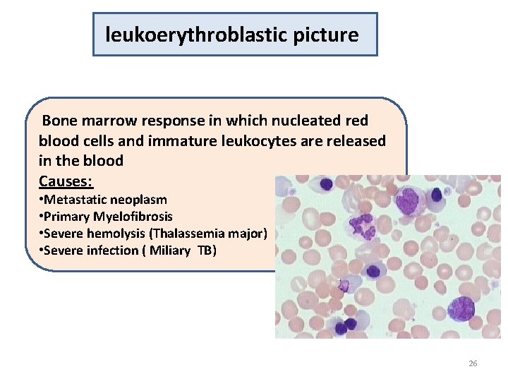 leukoerythroblastic picture Bone marrow response in which nucleated red blood cells and immature leukocytes