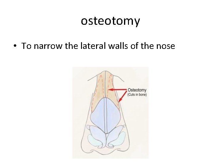 osteotomy • To narrow the lateral walls of the nose 
