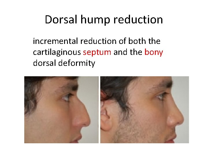 Dorsal hump reduction incremental reduction of both the cartilaginous septum and the bony dorsal