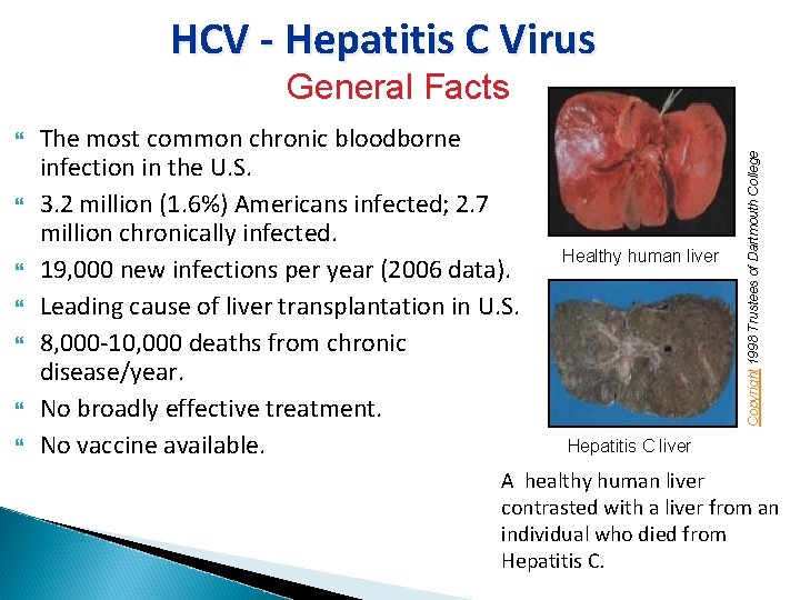 HCV - Hepatitis C Virus The most common chronic bloodborne infection in the U.