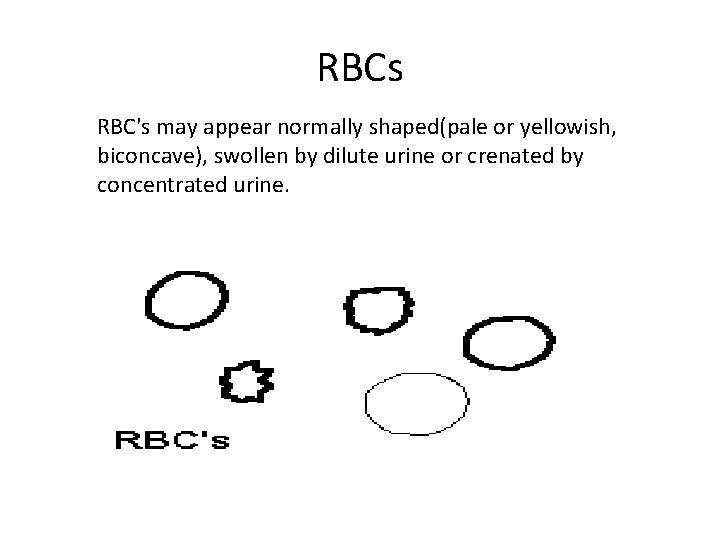 RBCs RBC's may appear normally shaped(pale or yellowish, biconcave), swollen by dilute urine or