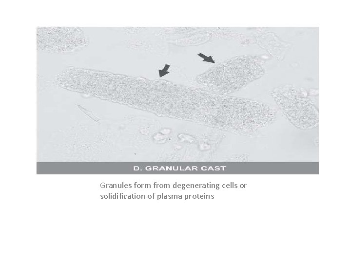 Granules form from degenerating cells or solidification of plasma proteins 