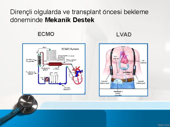 Dirençli olgularda ve transplant öncesi bekleme döneminde Mekanik Destek ECMO LVAD 