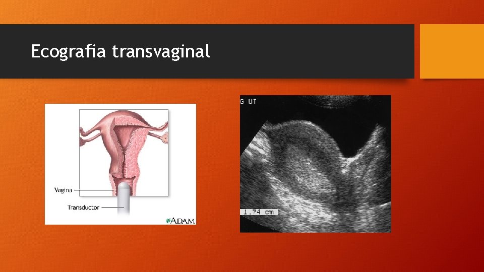 Ecografia transvaginal 