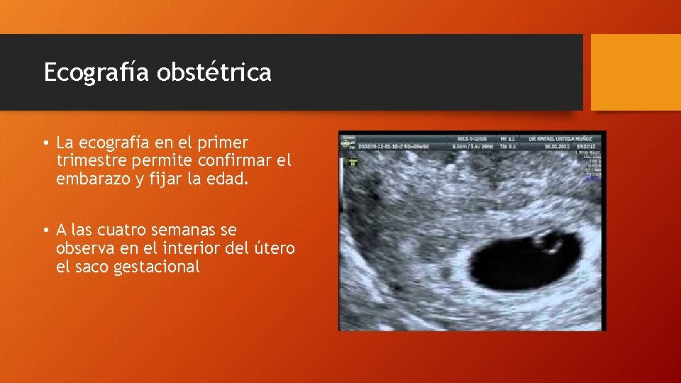 Ecografía obstétrica • La ecografía en el primer trimestre permite confirmar el embarazo y