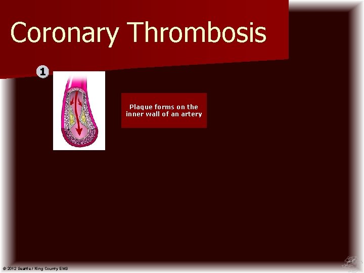 Coronary Thrombosis 1 Plaque forms on the inner wall of an artery © 2012