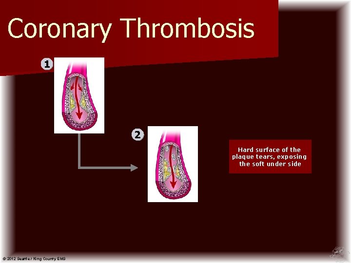 Coronary Thrombosis 1 2 Hard surface of the plaque tears, exposing the soft under