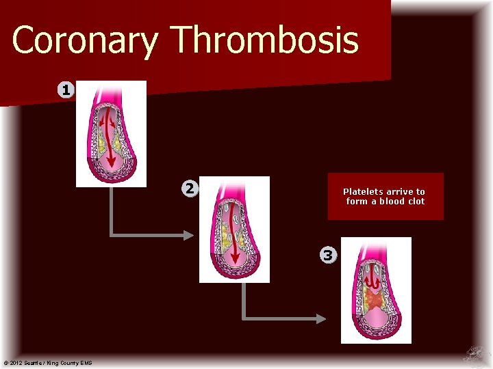 Coronary Thrombosis 1 2 Platelets arrive to form a blood clot 3 © 2012