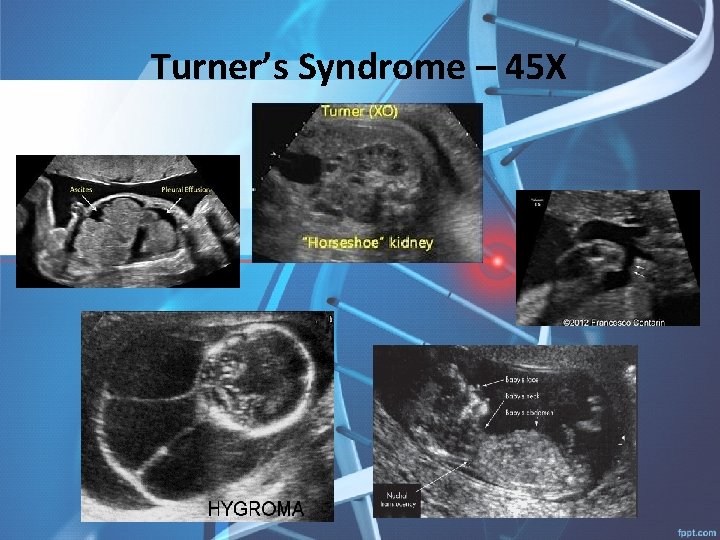 Turner’s Syndrome – 45 X 
