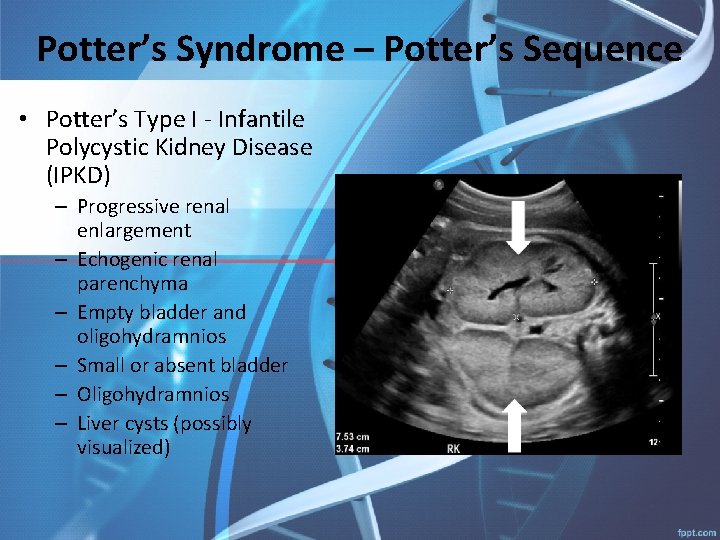Potter’s Syndrome – Potter’s Sequence • Potter’s Type I - Infantile Polycystic Kidney Disease