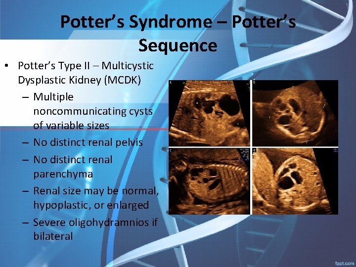 Potter’s Syndrome – Potter’s Sequence • Potter’s Type II – Multicystic Dysplastic Kidney (MCDK)