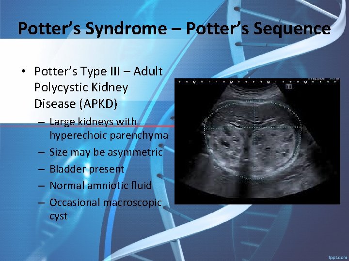 Potter’s Syndrome – Potter’s Sequence • Potter’s Type III – Adult Polycystic Kidney Disease