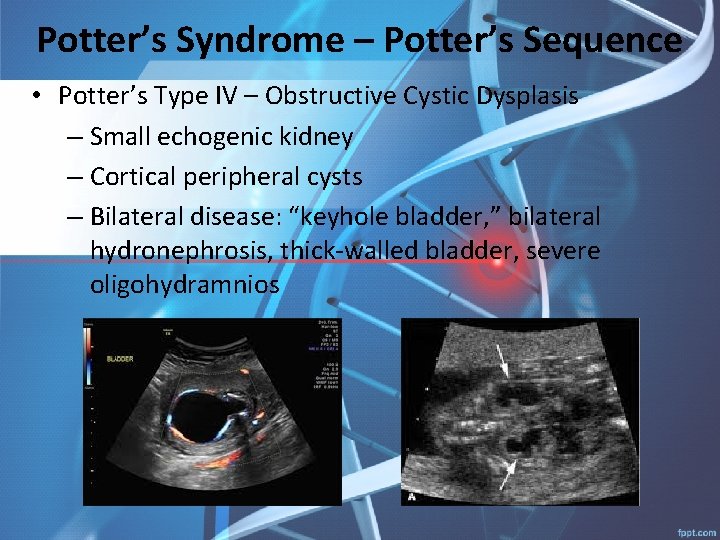 Potter’s Syndrome – Potter’s Sequence • Potter’s Type IV – Obstructive Cystic Dysplasis –