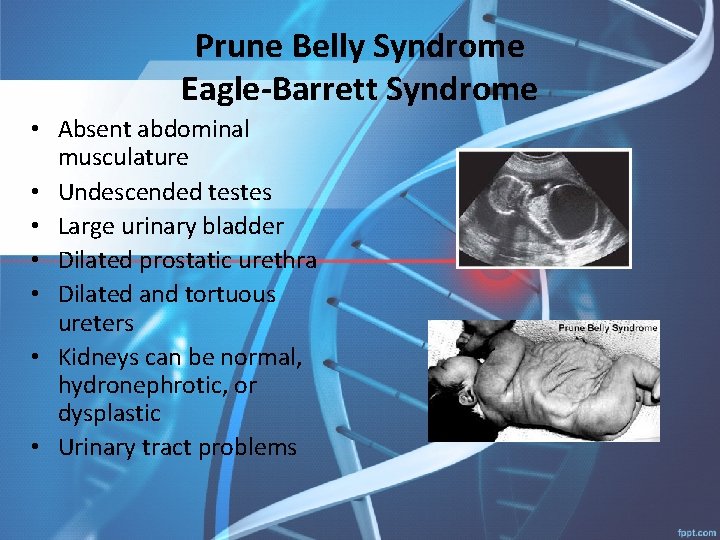 Prune Belly Syndrome Eagle-Barrett Syndrome • Absent abdominal musculature • Undescended testes • Large
