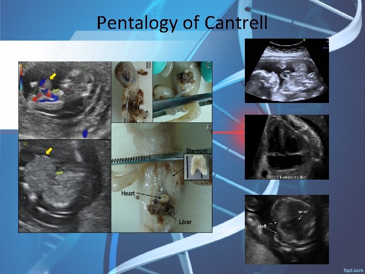 Pentalogy of Cantrell 