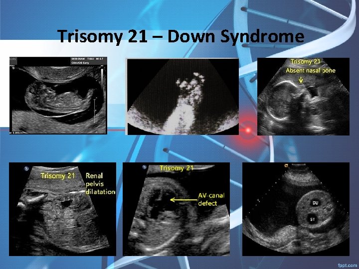 Trisomy 21 – Down Syndrome 
