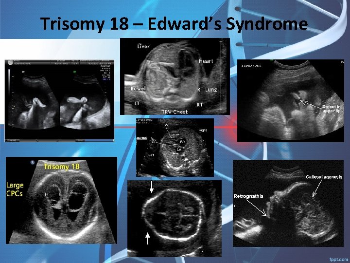 Trisomy 18 – Edward’s Syndrome 