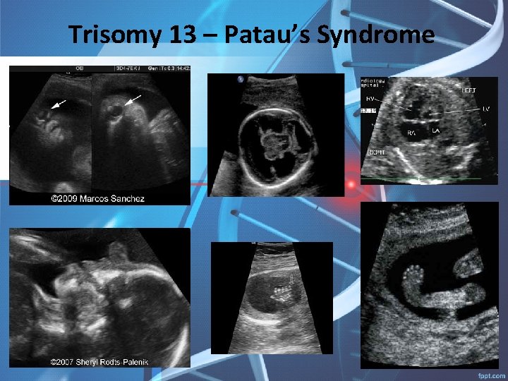 Trisomy 13 – Patau’s Syndrome 