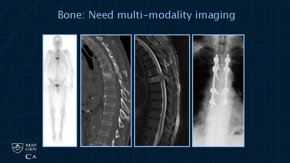 Bone: Need multi-modality imaging 