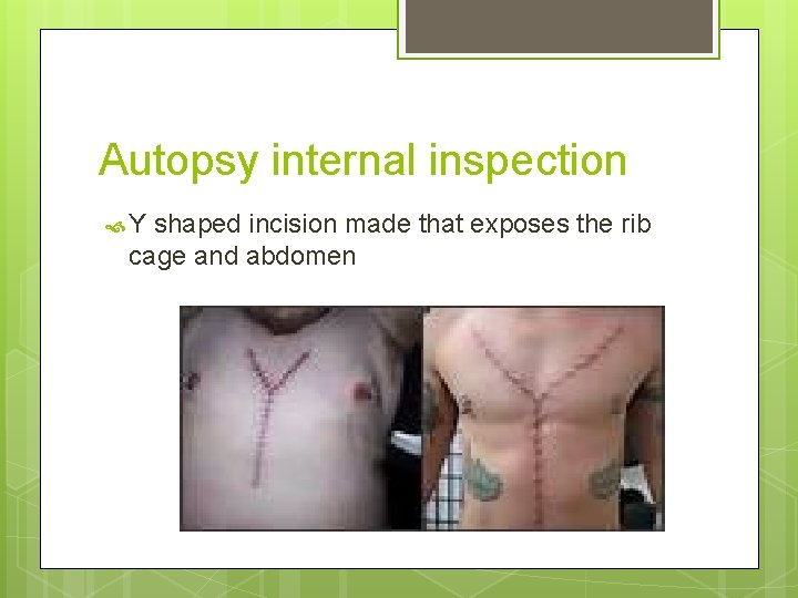 Autopsy internal inspection Y shaped incision made that exposes the rib cage and abdomen