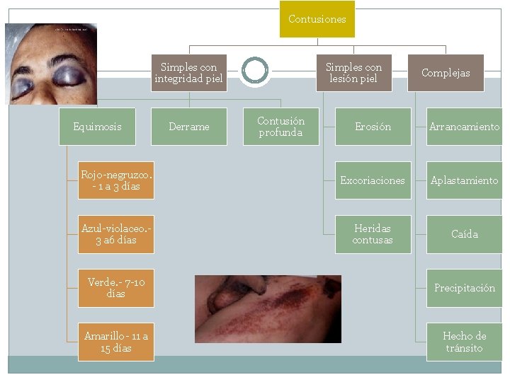 Contusiones Simples con integridad piel Equimosis Derrame Simples con lesión piel Contusión profunda Complejas