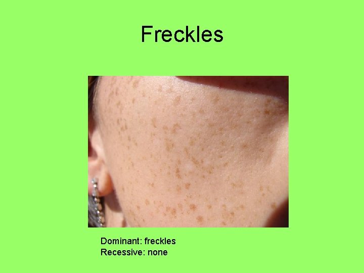 Freckles Dominant: freckles Recessive: none 