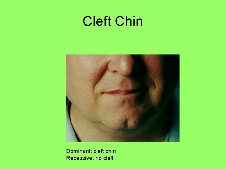 Cleft Chin Dominant: cleft chin Recessive: no cleft 