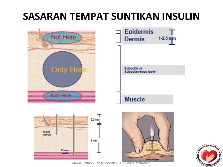 SASARAN TEMPAT SUNTIKAN INSULIN Modul Latihan Pengendalian NCD Untuk Paramedik 