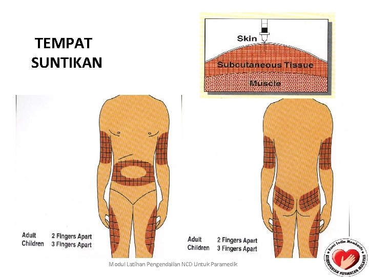 TEMPAT SUNTIKAN Modul Latihan Pengendalian NCD Untuk Paramedik 