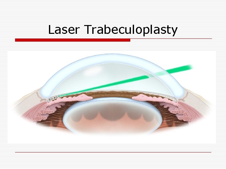Laser Trabeculoplasty 