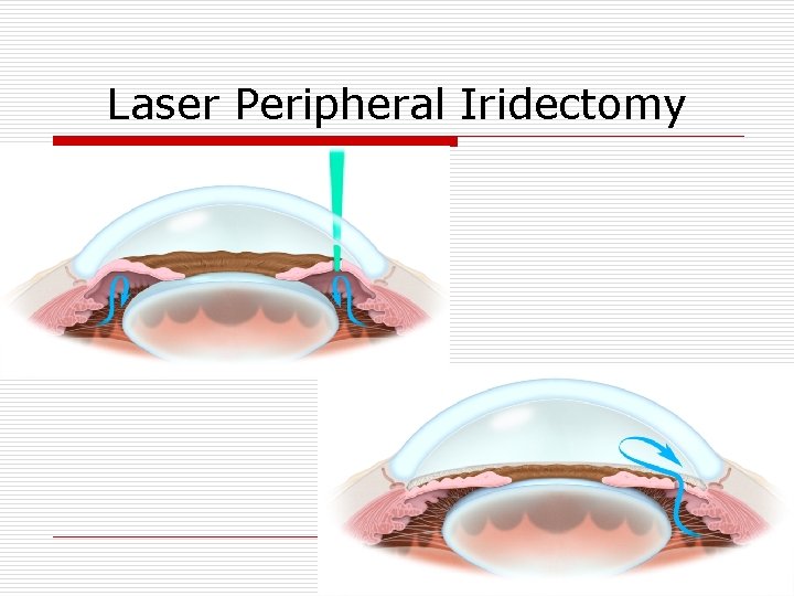Laser Peripheral Iridectomy 