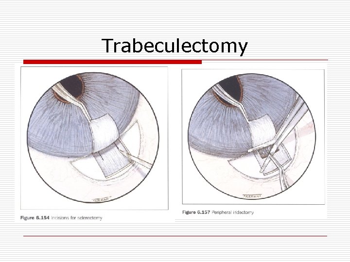 Trabeculectomy 