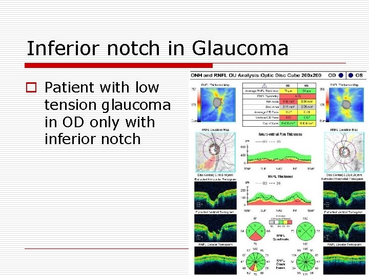 Inferior notch in Glaucoma o Patient with low tension glaucoma in OD only with