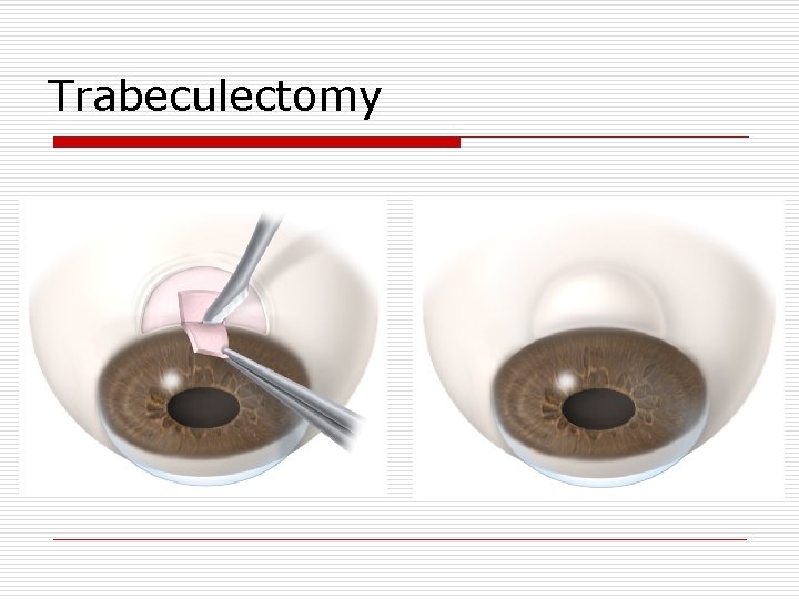 Trabeculectomy 