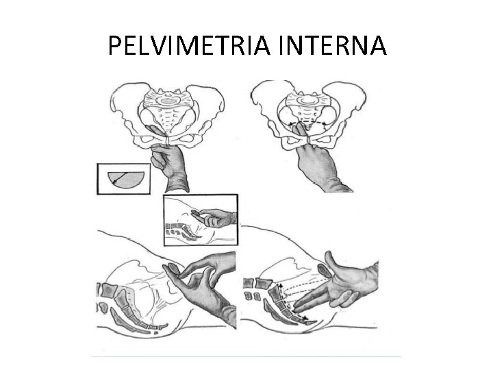 PELVIMETRIA INTERNA 