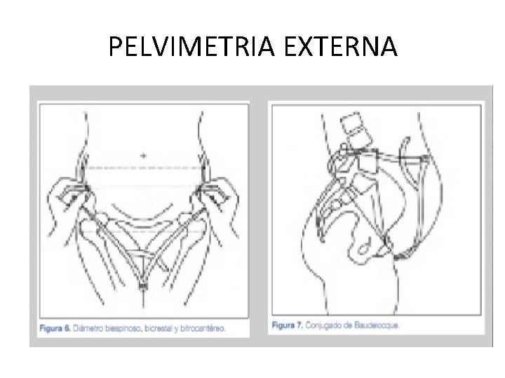 PELVIMETRIA EXTERNA 