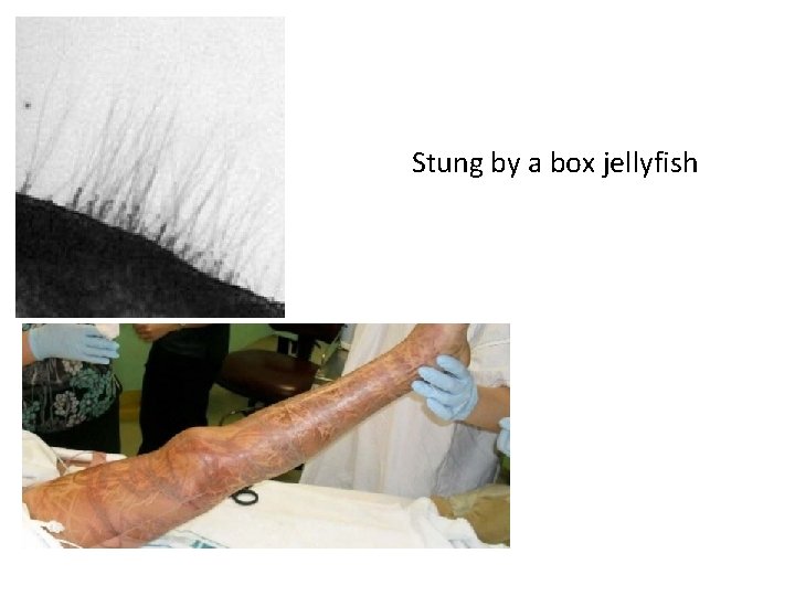 Stung by a box jellyfish 