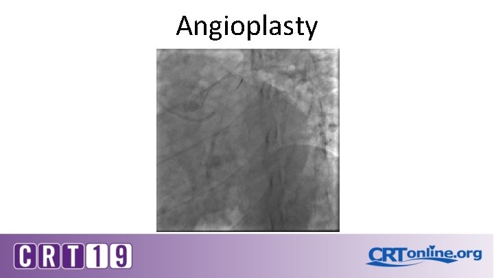 Angioplasty 