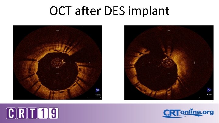 OCT after DES implant 