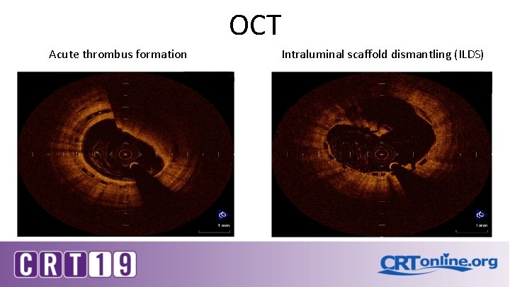 OCT Acute thrombus formation Intraluminal scaffold dismantling (ILDS) 