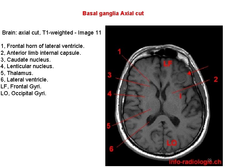 Basal ganglia Axial cut Brain: axial cut, T 1 -weighted - Image 11 1,