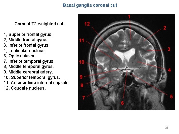 Basal ganglia coronal cut Coronal T 2 -weighted cut. 1, Superior frontal gyrus. 2,